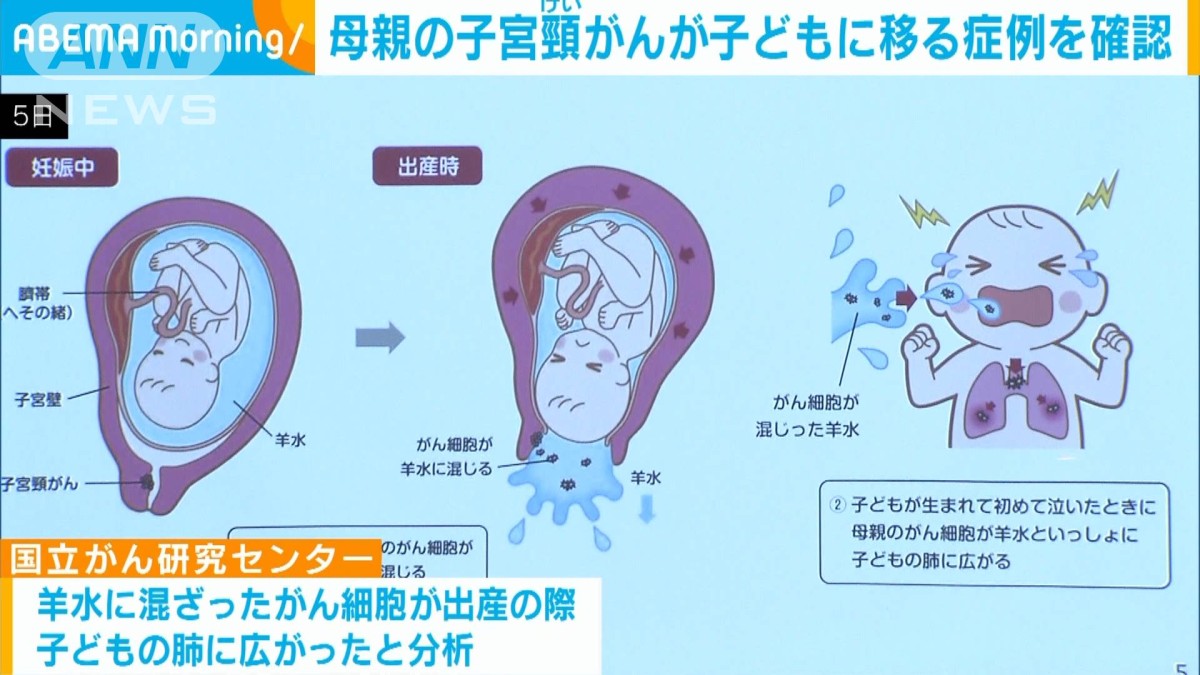母親の子宮けいがんが子どもに移る症例を確認