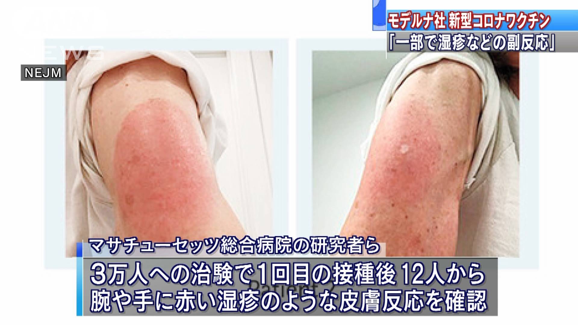 モデルナ社ワクチン 一部で 湿疹 のような反応 テレ朝news テレビ朝日のニュースサイト