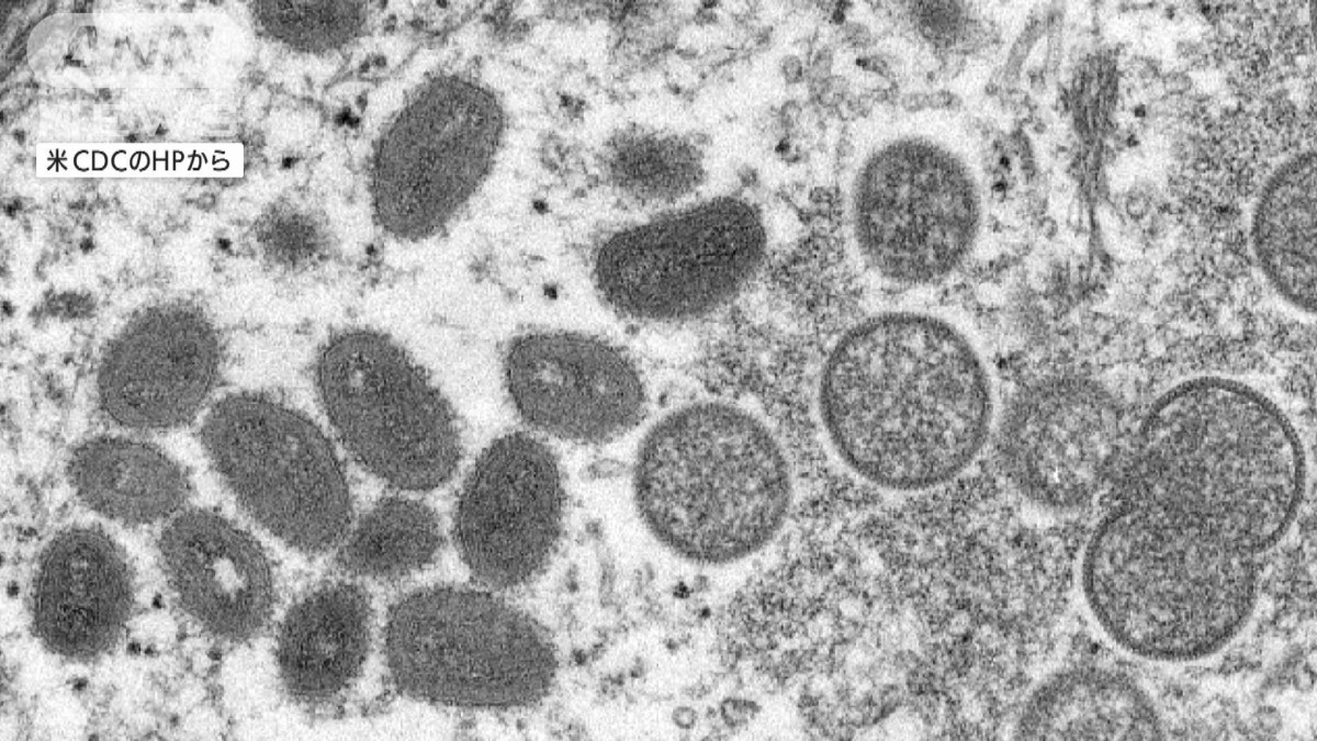 「サル痘」米でさらに5人の感染疑い例を確認、調査