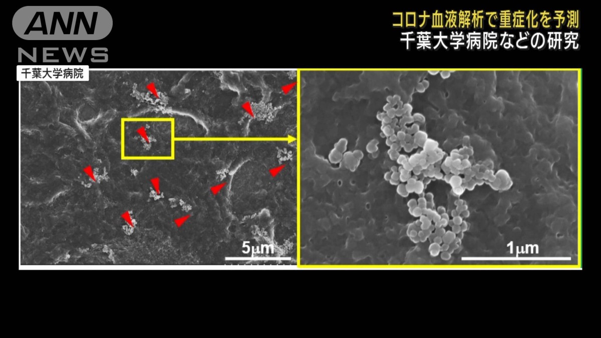 コロナ重症化を血液解析で予測　たんぱく質の濃度で