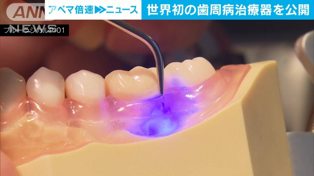 世界初「歯周病」の治療器販売へ 東北大発のベンチャー企業が約