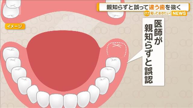 親知らずと誤認　歯茎に埋もれた別の歯を抜く　福井大病院　10代女性患者に謝罪