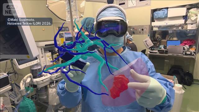 AI×医療で“命を守る”　患部の3D化で医師の負担軽減　日本ならではの課題も