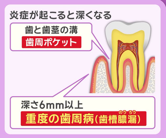 歯周ポケットの深さ6ミリ以上で『歯槽膿漏（のうろう）』