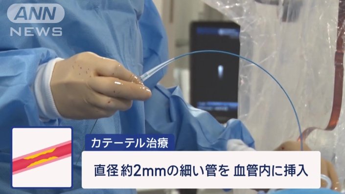 カテーテル治療