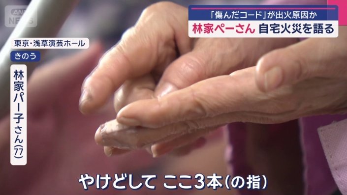 3本の指をやけど