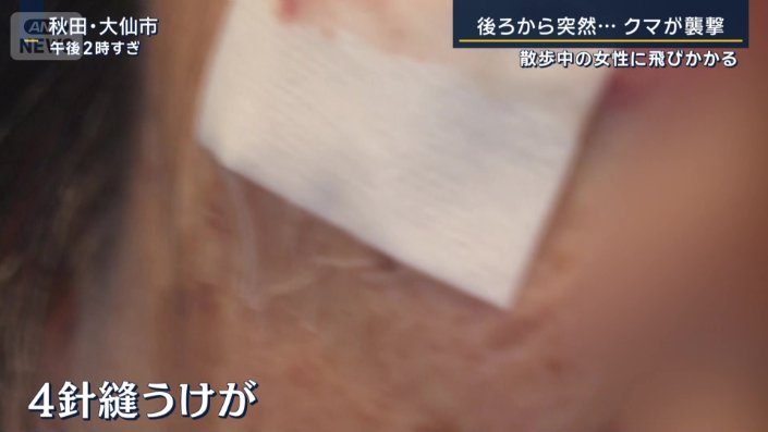 4針を縫うけが