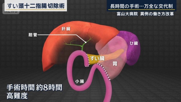すい頭十二指腸切除術