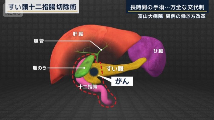 すい頭十二指腸切除術