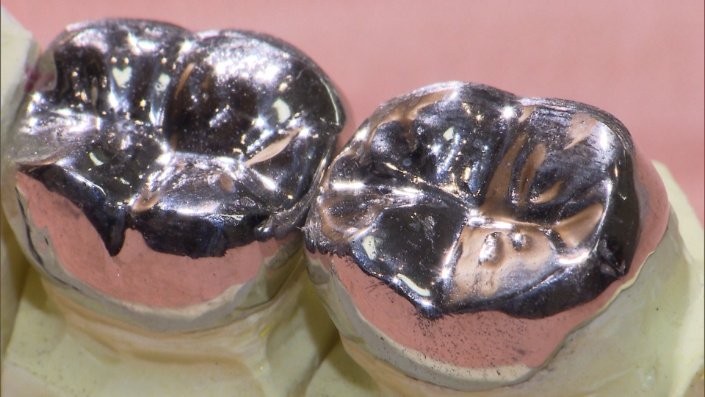 パラジウムの銀歯写真