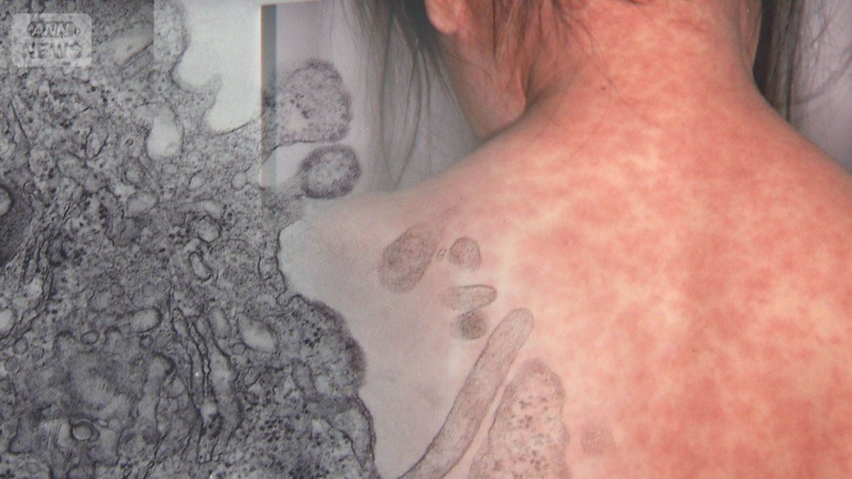 はしか感染が世界的に増加　先進国でも1000人に1人死亡　細胞破壊し「免疫白紙化」も