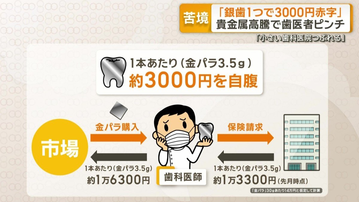銀歯1本あたり3000円自腹