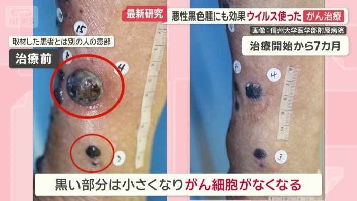 治療前（左）　治療開始から7か月（右）