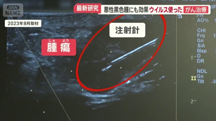 腫瘍にウイルスを投与