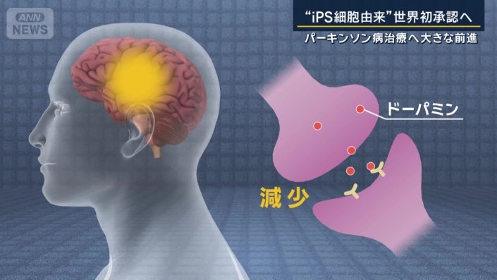 パーキンソン病の症状