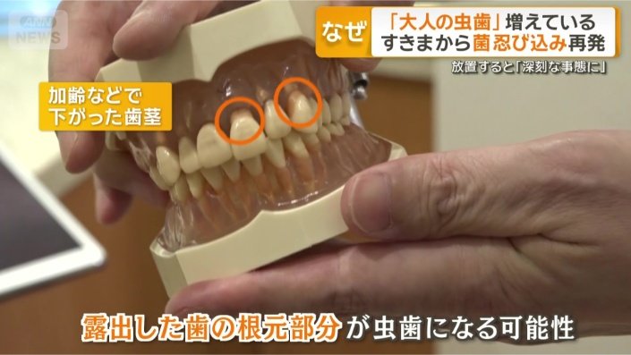 加齢などで歯茎が下がると…