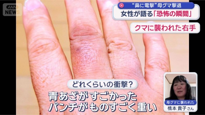 クマに襲われた右手