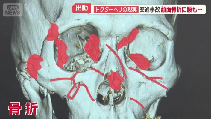 顔面の複数箇所で骨折が判明