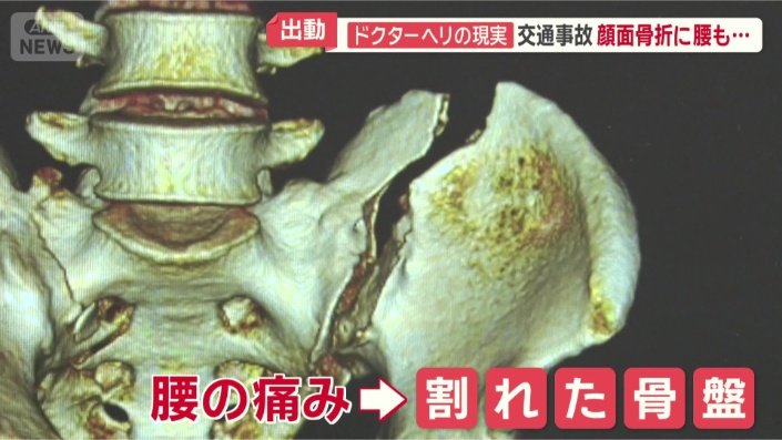 骨盤も大きく2つに