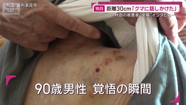 クマに襲われた男性