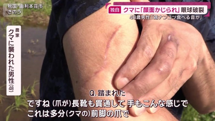 クマに襲われた男性