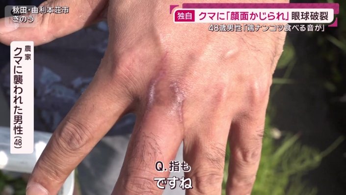 クマに襲われた男性