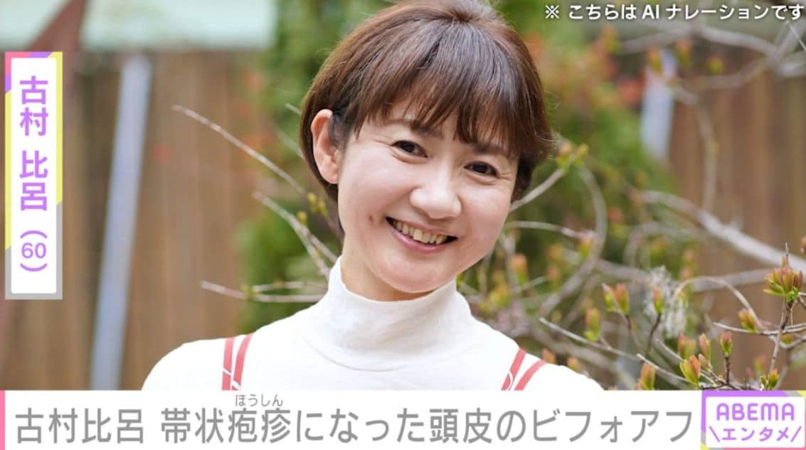 子宮頸がん“再々再発”古村比呂（60）、頭皮の帯状疱疹で抜け落ちた髪のビフォーアフターを投稿
