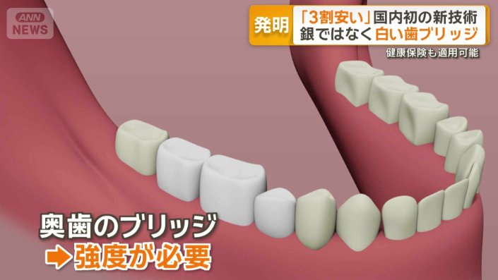 ブリッジ治療