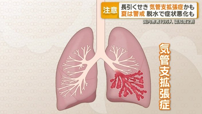 気管支拡張症